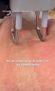 Láser Co2 - Vídeo a cámara lenta Créditos: @jorgefelixgarcia