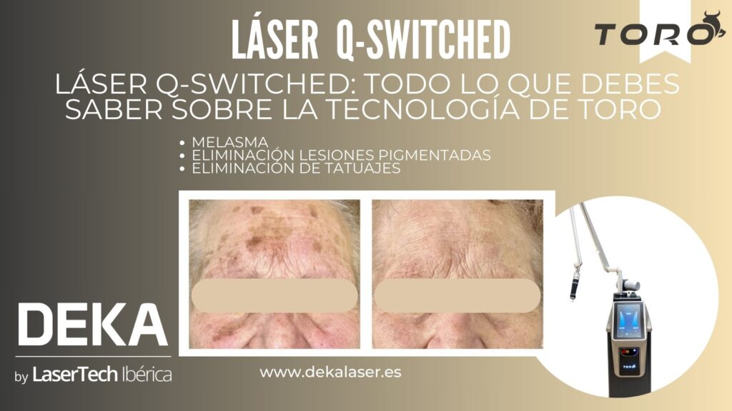 Q-switched TORO DEKA