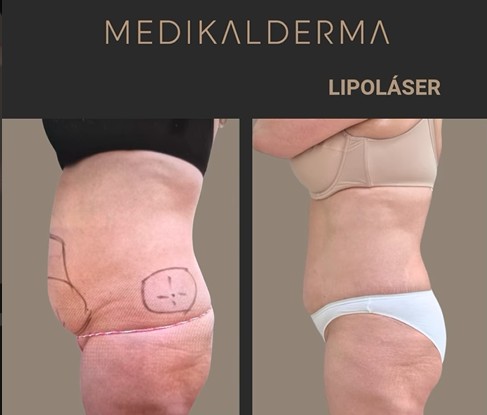 Smartlipo laserlipolisis DEKA lipolaser Dr.Javier Garcia del Monte