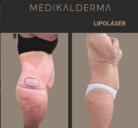 Smartlipo laserlipolisis DEKA lipolaser Dr.Javier Garcia del Monte