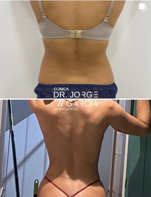 smartlipo deka Dr.Jorge Feliz laserlipolisis eliminacion grasa abdomen