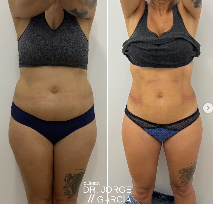 smartlipo DEKA Grasa abdominal antes y despues laserlipolisis Dr.Jorge Felix Garcia