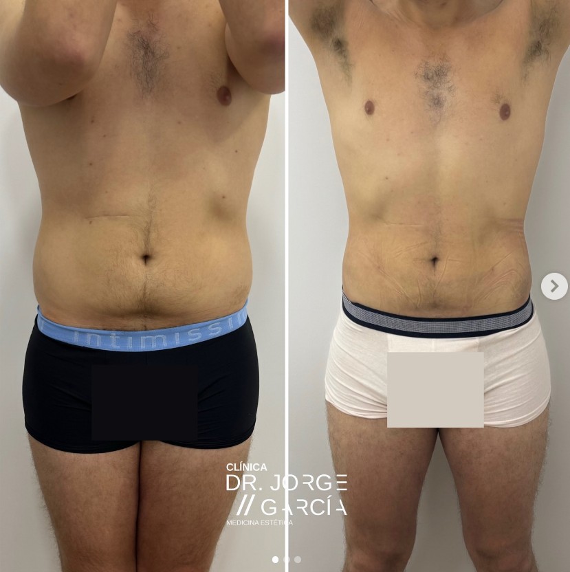 smartlipo DEKA Grasa abdominal antes y despues laserlipolisis Dr.Jorge Felix Garcia