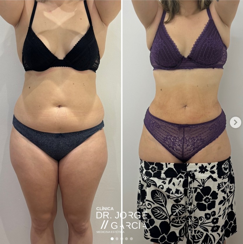 smartrlipo laserlipolisis deka