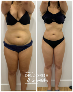 smartlipo DEKA Grasa abdominal antes y despues laserlipolisis Dr.Jorge Felix Garcia