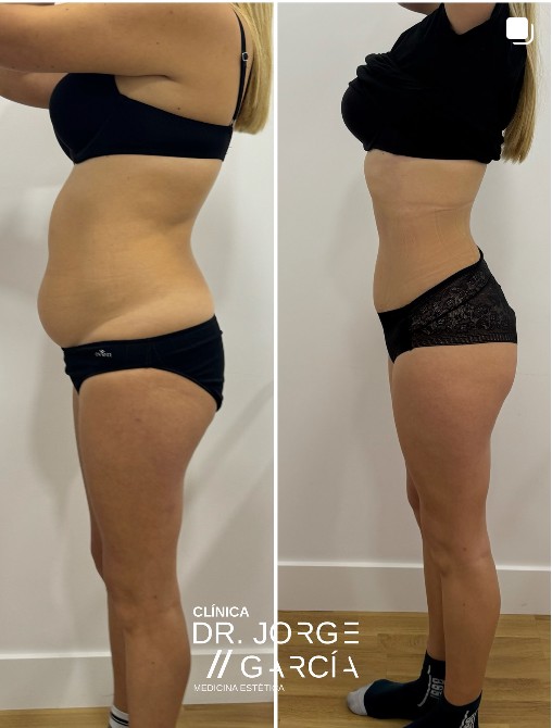 smartlipo deka antes y despues resultados Dr.Jorge Felix 