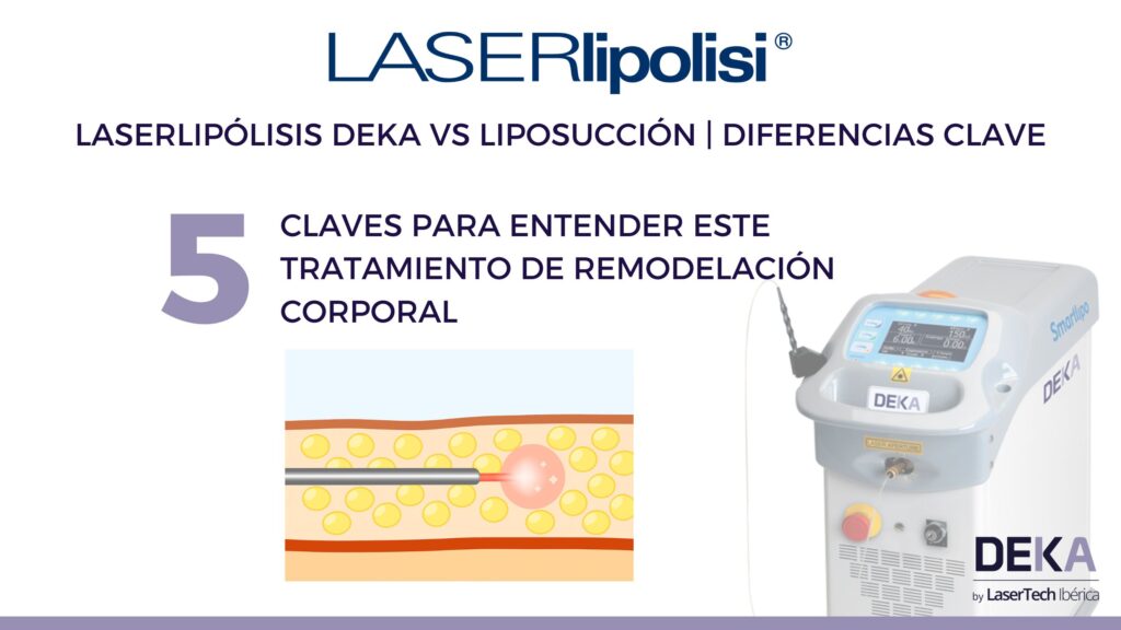 laserlipolisis con el smartlipo DEKA