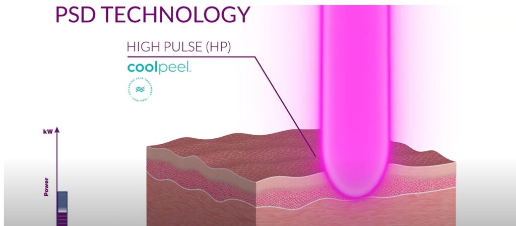 laser fraccionado coolpeel DEKA LASER rejuvenecimiento, acne, cicatrices, blefaro sin cirugia