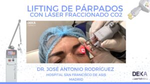 lifting de parpados laser co2 DEKA - Dr. Jose Antonio Rodriguez