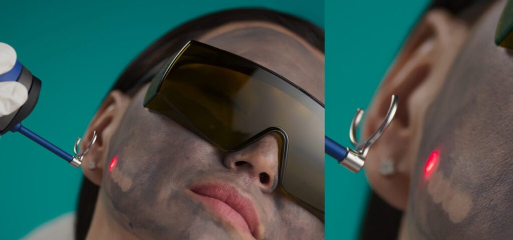 Laser q-switched TORO melasma lesiones pigmentadas DEKA 10 carbon peel DEKA PEEL