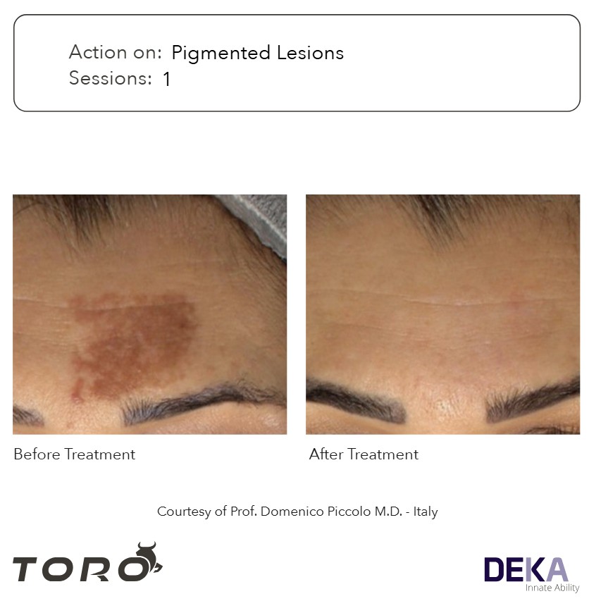 resultados antes y despues laser q-switched melasma Q-lesiones pigmentadas - post 1 sesion