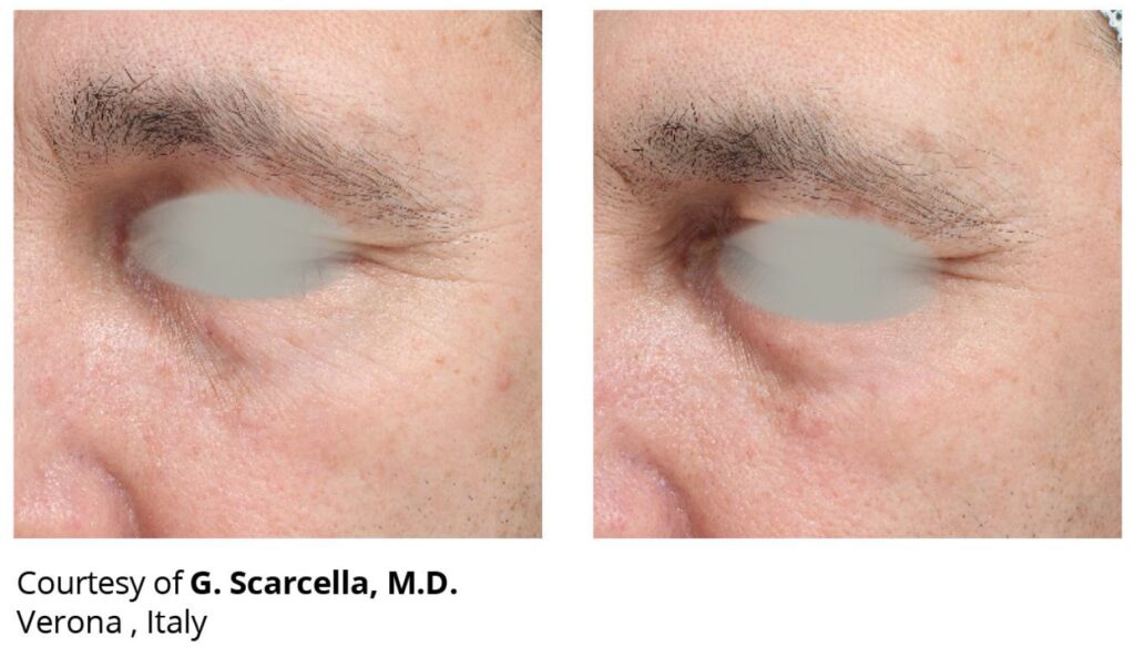 Laser co2 Duoglide DEKA antes y despues arrugas 1