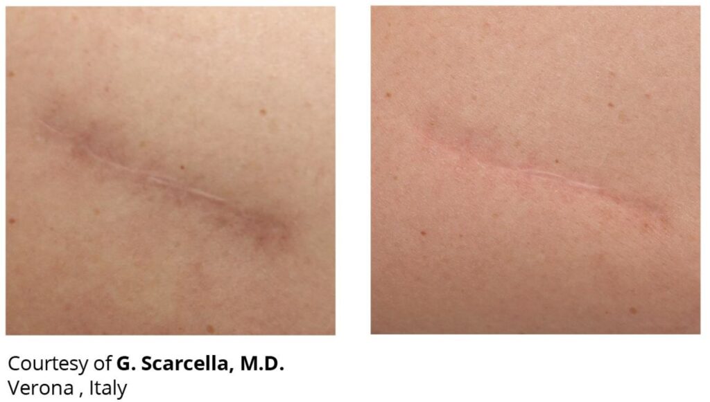 Laser co2 Duoglide DEKA antes y despues cicatrices