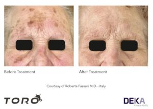 TORO DEKA laser pigmentacion, q-switched y pico segundos