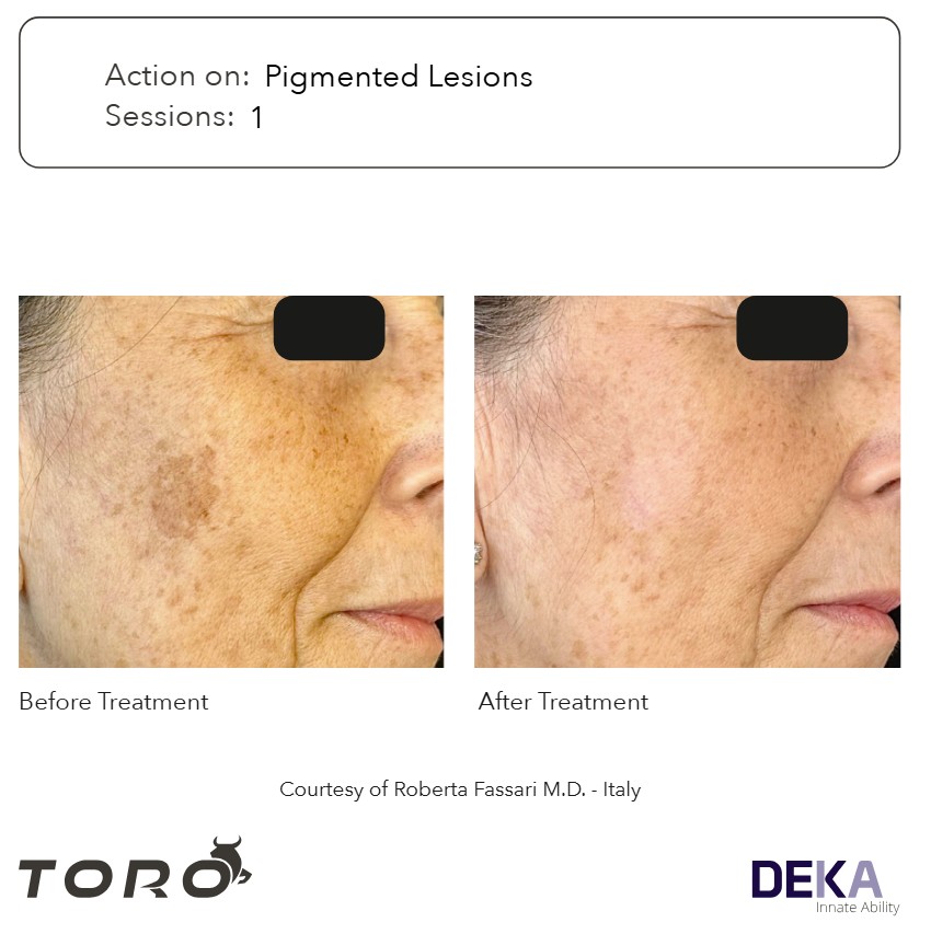 Manchas solares: elimina con láser TORO de DEKA
melasma, manchas solares. lesiones pigmentadas