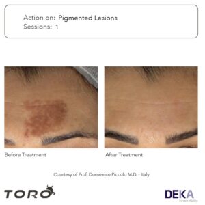 Manchas solares: elimina con láser TORO de DEKA. Laser Q-switch TORO - 5 - lesiones pigmentadas - post 1 sesion