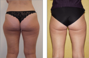 antes y despues de laserlipolisis eliminacion de grasa en cartucheras con laser smartlipo DEKA
