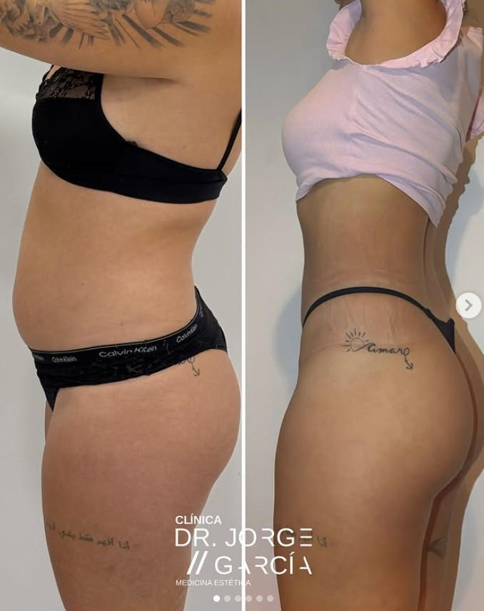 Smartlipo laserlipolisis DEKA antes y despues Dr.JOrge Garcia