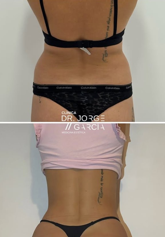 Smartlipo laserlipolisis DEKA antes y despues Dr.Jorge Garcia
