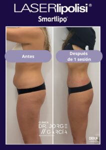 antes-despues-smartlipo-laserlipolisis-abdomen-mujer