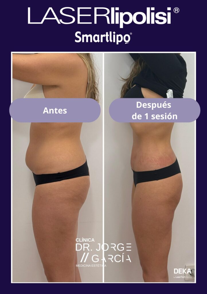 antes-despues-smartlipo-laserlipolisis-abdomen-mujer