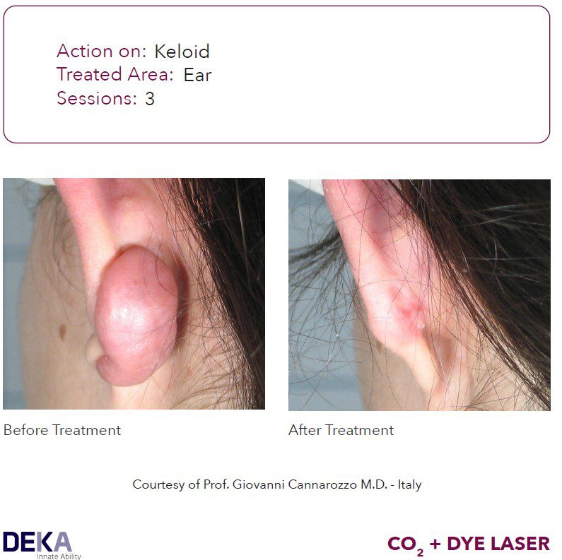 laser queloide DYE colorante pulsado Synchro vas Q resultados antes y despues DEKA 5