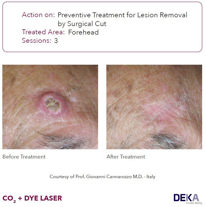 laser DYE colorante pulsado Synchro vas Q resultados antes y despues DEKA 6