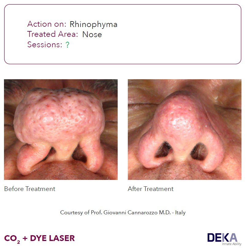 laser rinofima DYE colorante pulsado Synchro vas Q resultados antes y despues DEKA 7