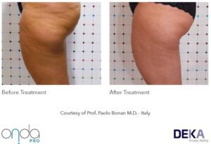 aparatologia onda pro celulitis gluteos resultados antes y despues ONDA PRO DEKA