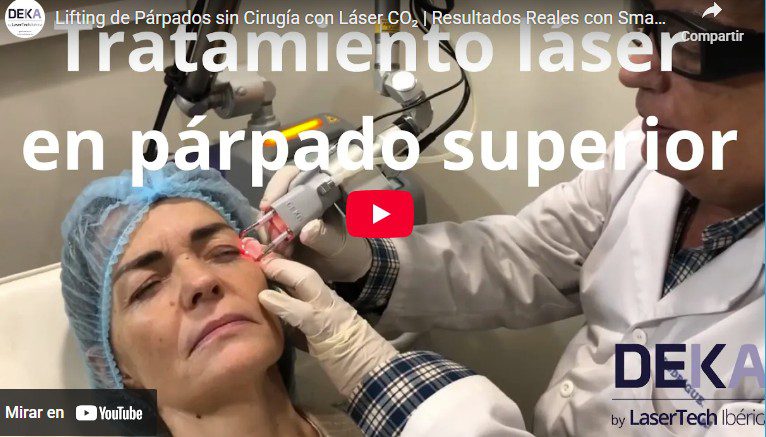 laser co2 parpados blefaro sin cirugia DEKA