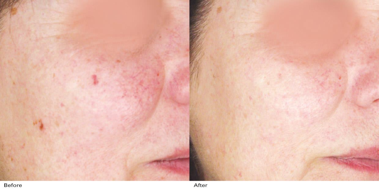 resultado foto antes y despues resultados IPL