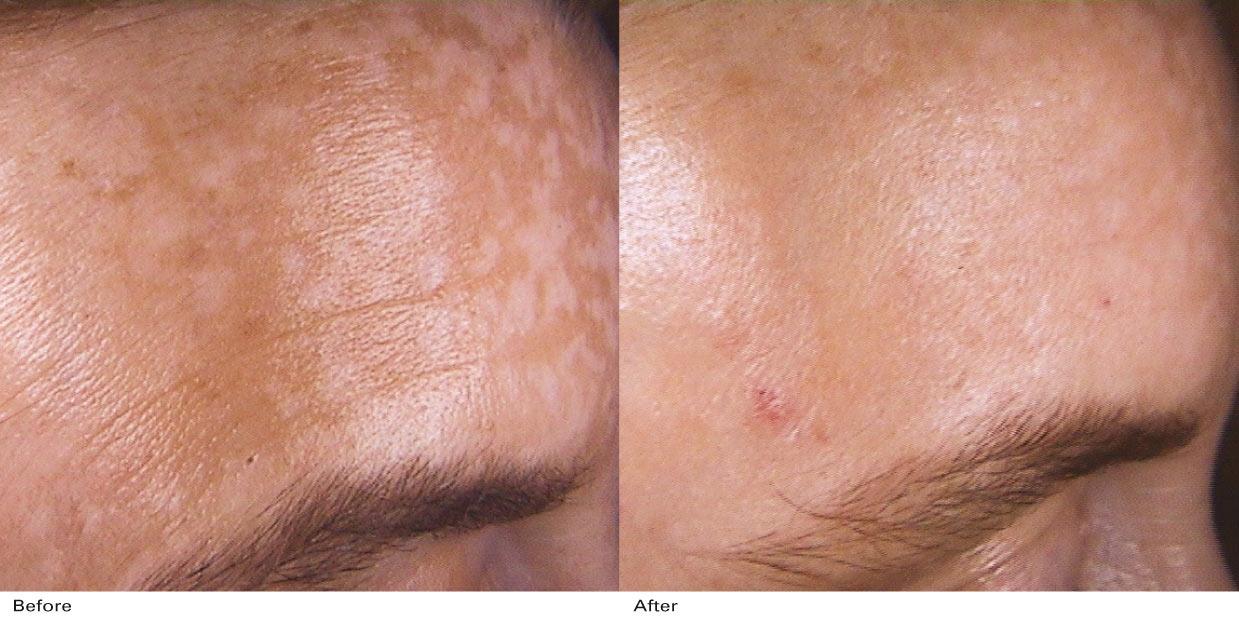 antes y despues manchas faciales, melasma, lesiones pigmentadas Minisilk DEKA