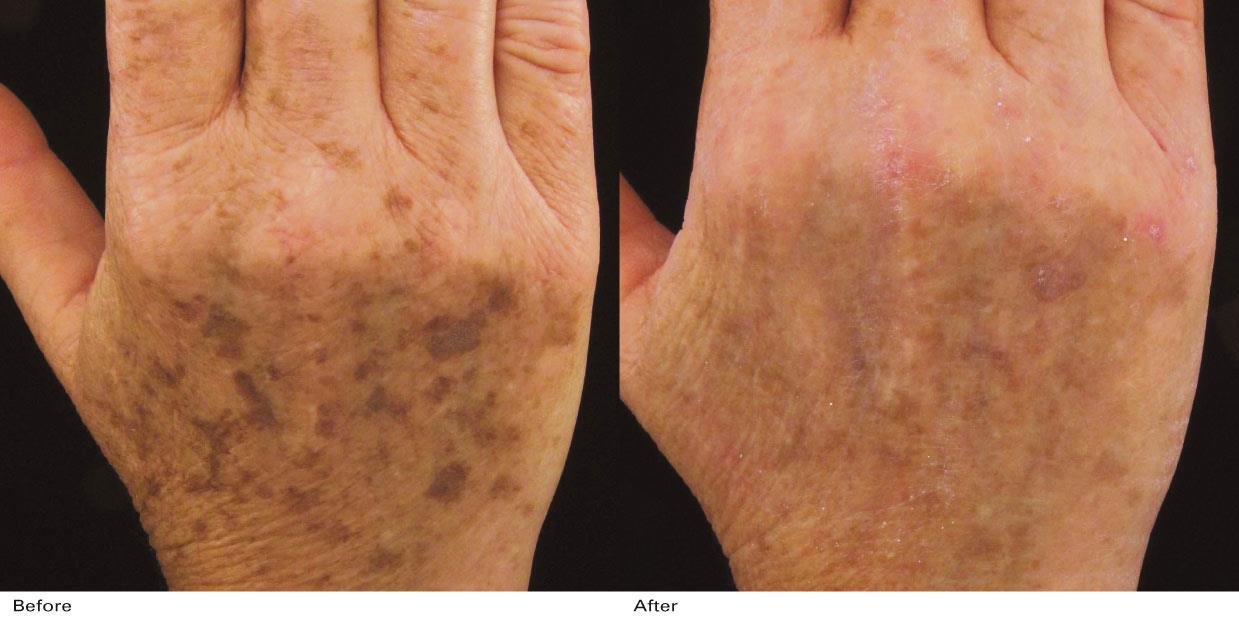 antes y despues luz pulsada manchas manos pigmentacion