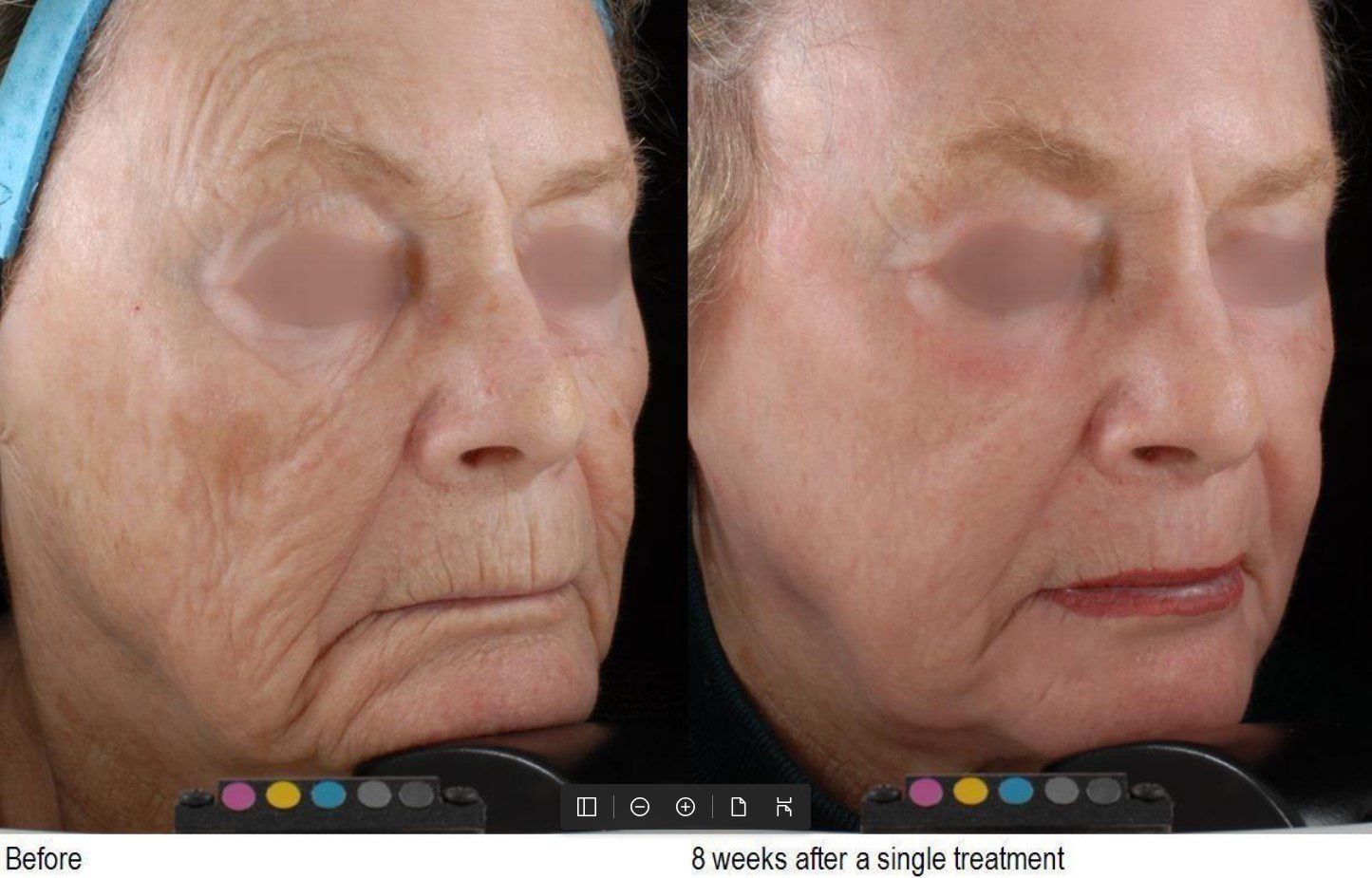 Antes y después de tratamiento con laser co2 DEKA para rejuvenecimiento facial y mejora de arrugas profundas