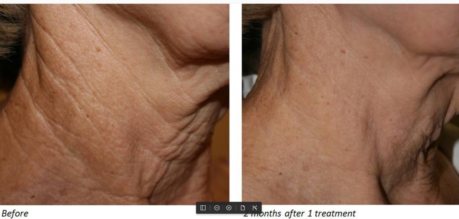 Antes y después de tratamiento con laser co2 DEKA para rejuvenecimiento facial y mejora de arrugas profundas del cuello