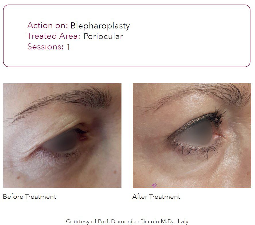Resultados clínicos de laser co2 fraccionado DEKA en parpados caidos para mejorar la mirada, sin cirugia. Lifting de parpados con laser.