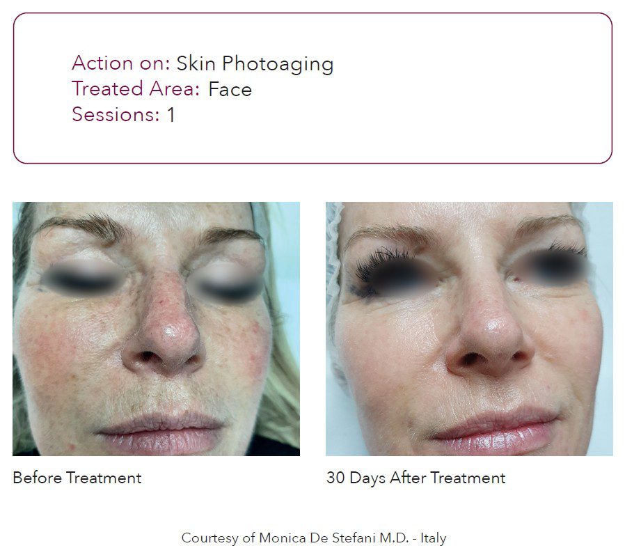 Resultados clínicos de laser co2 fraccionado DEKA en piel fotoenvejecida con mejora visible de textura