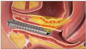 láser vaginal CO2 microablativo mecanismo de acción en cistitis recurrente regeneración mucosa urogenital