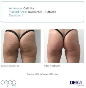 Antes y después de celulitis en glúteos y cartucheras con ONDA PRO en 1 sesión – mejora visible sin cirugía