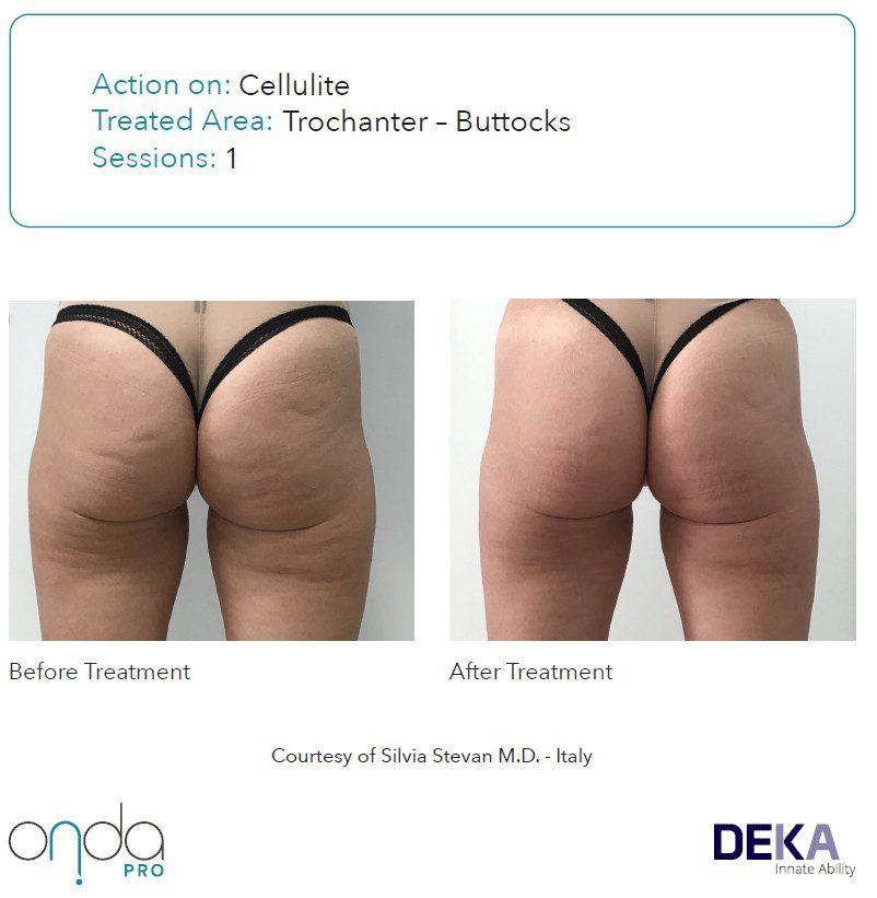 Antes y después de celulitis en glúteos y cartucheras con ONDA PRO en 1 sesión – mejora visible sin cirugía