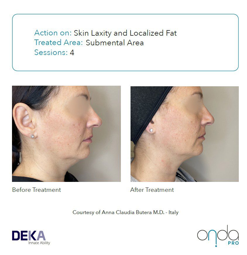 Antes y después de flacidez submentoniana con ONDA PRO tras 4 sesiones – reducción de papada sin cirugía