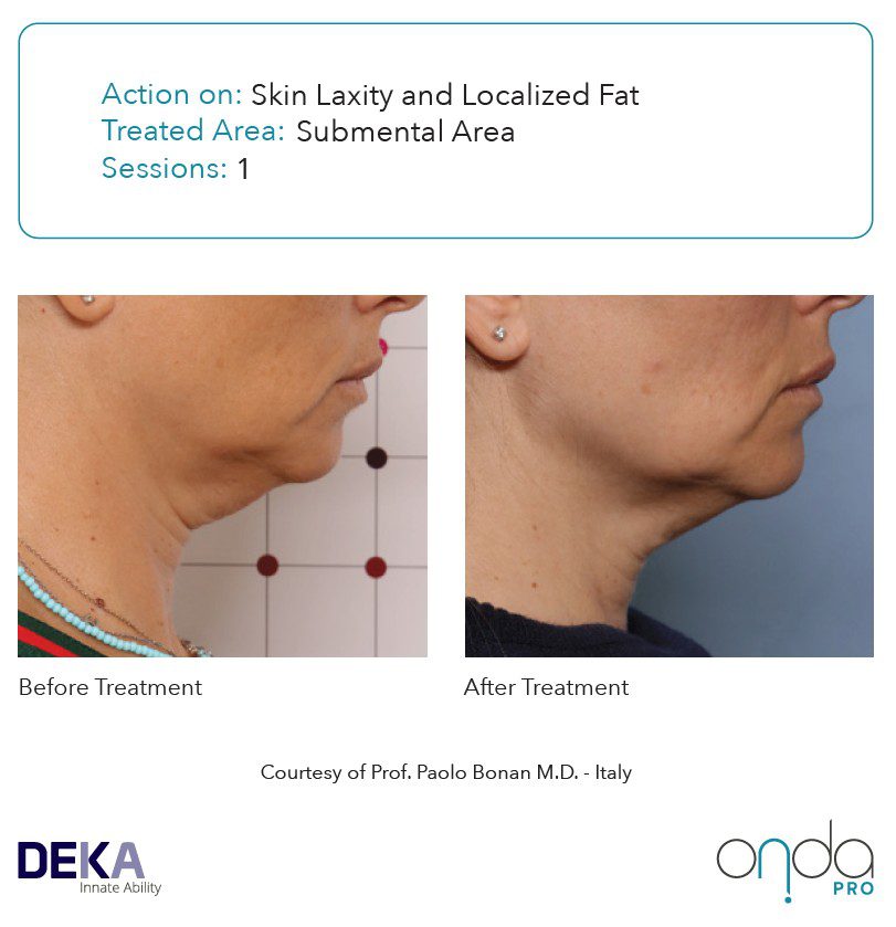 Antes y después de papada con ONDA PRO en 1 sesión – reducción visible de flacidez y grasa submentoniana sin cirugía