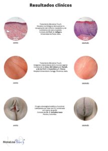 Láser CO2 Monalisatouch - Smartxide Punto - ginecologia