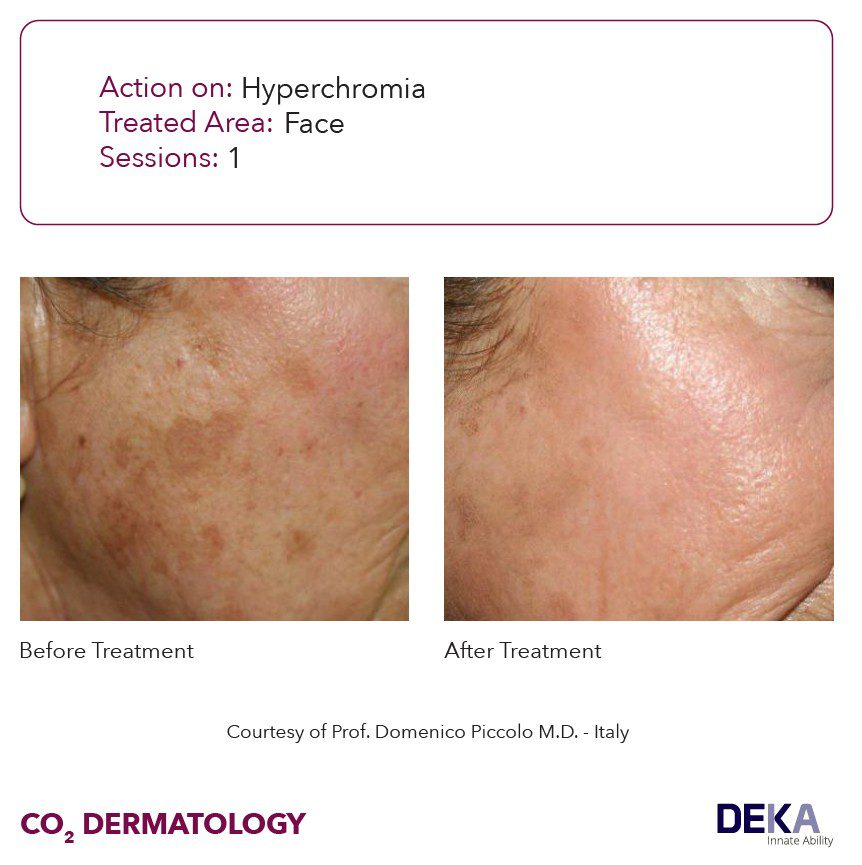 antes y despues laser co2