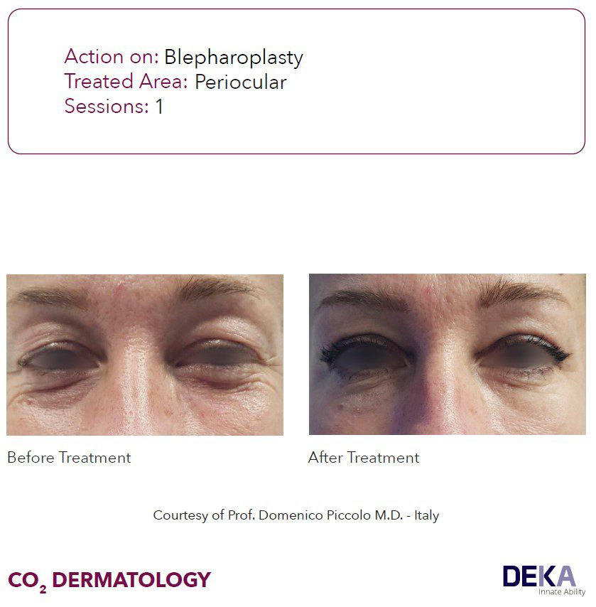 antes y despues laser co2 parpados lifting laser