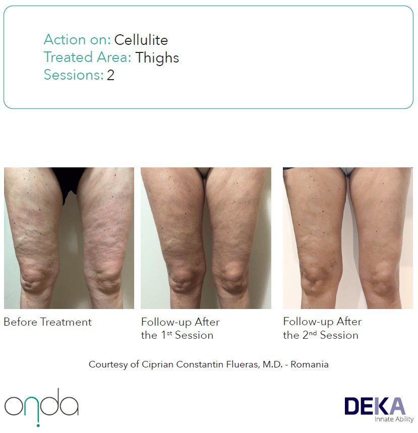 Mejora de la celulitis en muslos tras protocolo de tratamiento ONDA®.