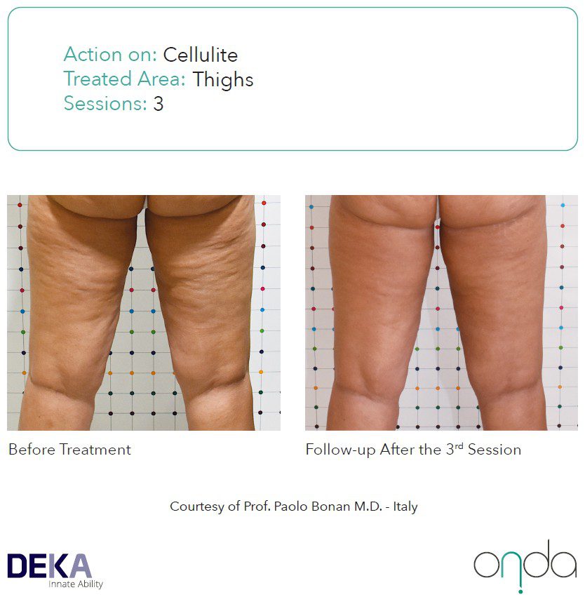 Antes y después de tratamiento ONDA® para reafirmación y remodelación de muslos.