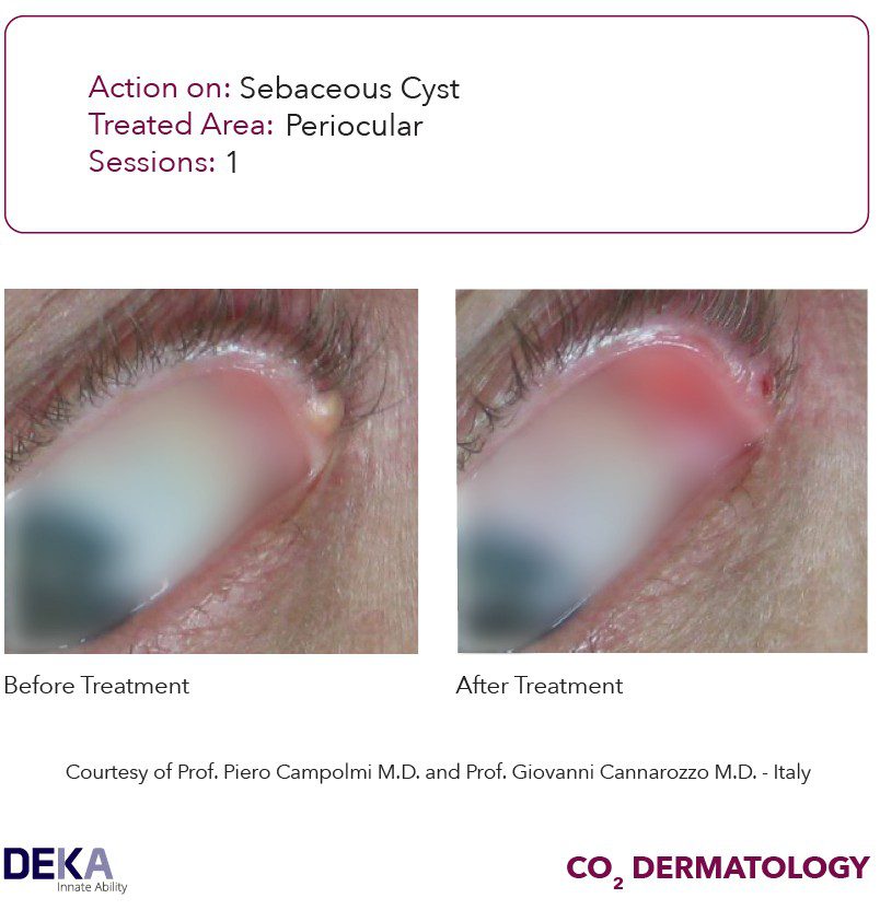 laser cirugia ocular dermatologia