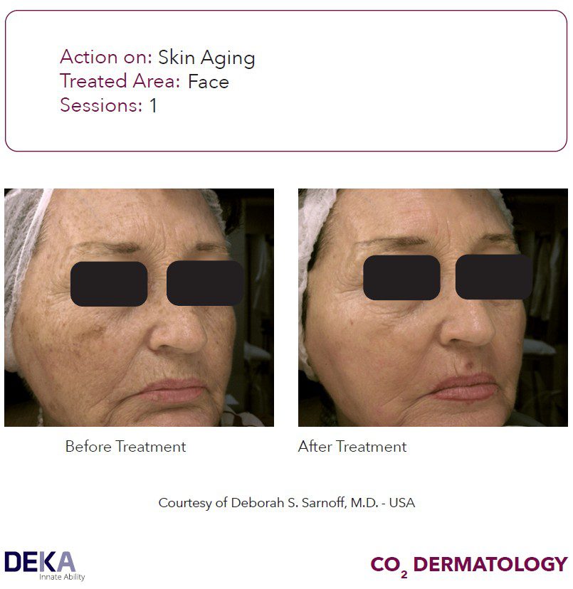 antes y despues laser co2 DEKA - arrugas y manchas faciales