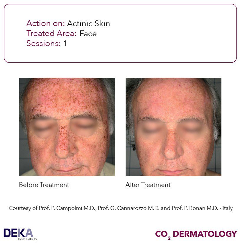 antes y despues laser co2 DEKA - manchas cara